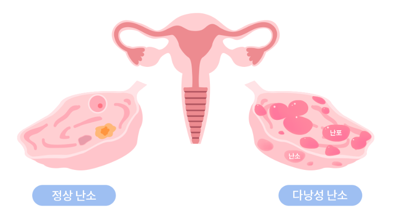 다난성 난소증후군 증상과 치료 여성 건강 가이드